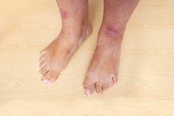 rash, hives, itchy skin on legs, inflammation and allergy, disease on body of female patient,...