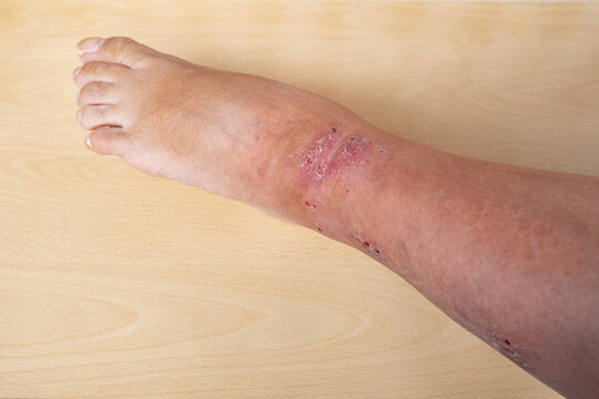 closeup weeping wounds, venous ulcers on female leg, diabetes mellitus, varicose veins, healing ulcers by destroying growth factors, eliminating inflammatory process, sanitation pathogenic microflora