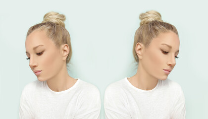 Thinning hair and hair loss,female pattern baldness,Hair transplant