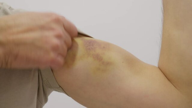 Man showing his bruise on forearm. real huge colored hematoma on hand close up 