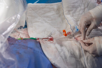 Interventional cardiology. Surgeon doctor at operation. Stent and catheter for implantation into...