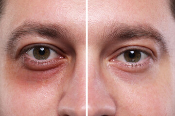Collage with photos of man with dark circle under eye before and after treatment, closeup - obrazy, fototapety, plakaty