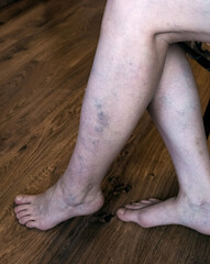 Female legs below the knee with visible signs of varicose veins. The skin on the legs has...
