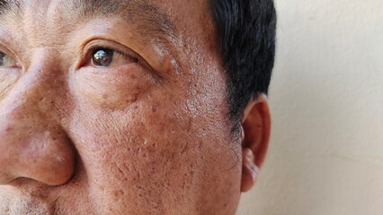 close up showing the wrinkle and Flabby skin, forehead and blemish, freckles and loose, rash and...