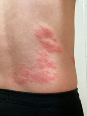 腹部の帯状疱疹