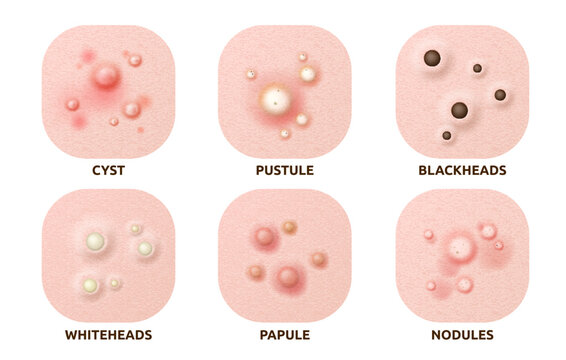 Body skin acne type blackheads, whiteheads, papule, pustule, cyst and nodules. Realistic 3d vector skin disease caused by excess oil production, bacteria, and inflammation, hormonal changes or sweat