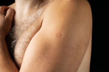 A Mark of Protection: Vaccination Spot on a Middle-Aged Man's Arm - obrazy, fototapety, plakaty