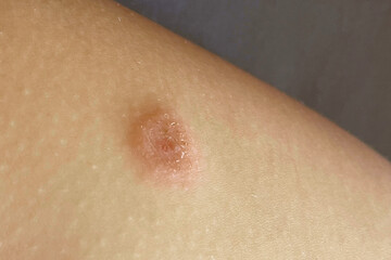 Fototapeta premium Close up of skin problem. Infectious disease. Allergy, dermatitis, virus or bacterial infection. Dermatology, medicine and health care concept.