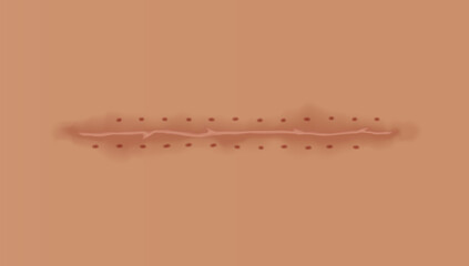 Healing wounds, skin scar, stitched gash and cut. Realistic surgical suture, stitched wounds. Healing stage on human skin background. illustration