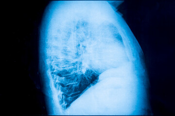 Profile x-ray of lungs. Radiography - 775058960