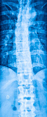X-ray of spine affected by scoliosis frontal view. - 775059739