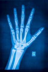 Normal left hand radiograph. Radiography - 775059939