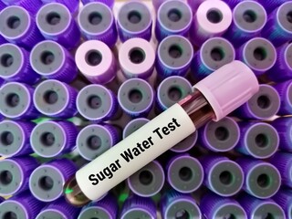 Blood sample for Sugar Water Test, to diagnose paroxysmal nocturnal hemoglobinuria (PNH). HAM'S...