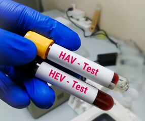 Blood samples in virologist hand for  HAV (Hepatitis A) and Hepatitis E (HEV) test.