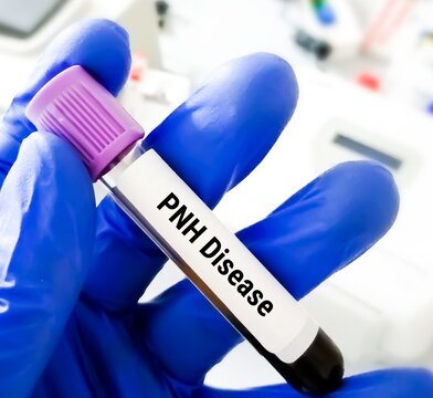 Blood sample for Paroxysmal nocturnal hemoglobinuria (PNH) disease test. HAM'S Test.
