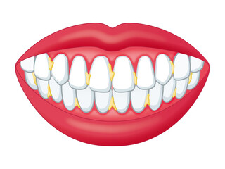 歯垢が付いた歯