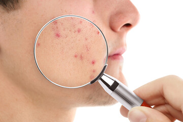 Dermatologist looking at man's face with magnifying glass on white background, closeup. Zoomed view on acne