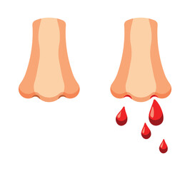 Set of illustrations. Healthy human nose. Nosebleeds occur due to a fight, illness, or high blood pressure.