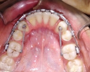 treatment in the dentist