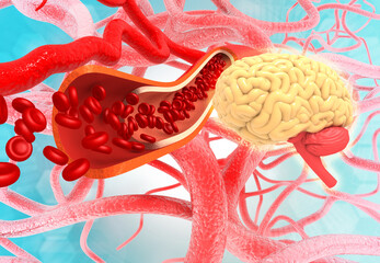 Human brain stroke concept. Clogged vein in brain. 3d illustration..