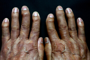 老人の手指の病気のクローズアップ