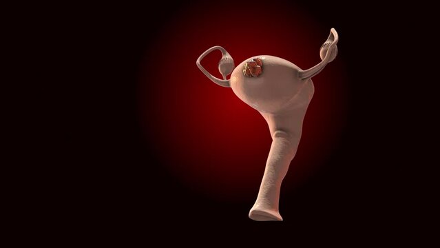 Fibroid Tumor or Fibroid Cancer