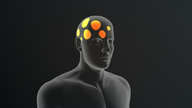 Types of Headache (Ice pick) 3d illustration