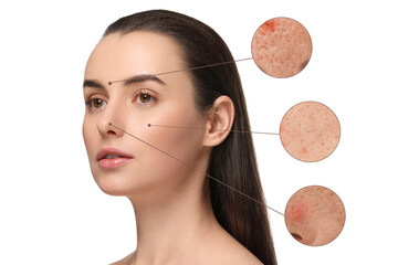 Dermatology. Woman with skin problem on white background. Zoomed areas showing acne
