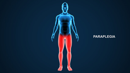 Paraplegia type paralysis 3d Illustration