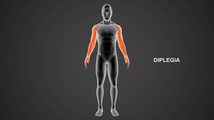 Diplegia type paralysis 3d Illustration