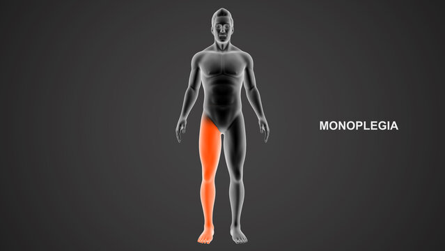 Monoplegia type paralysis 3d Illustration