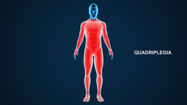 Quadriplegia type paralysis 3d Illustration