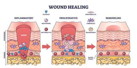 Process of wound healing and anatomical body injury repair outline diagram, transparent background. Labeled educational scheme with medical epidermis skin inflammatory, proliferative.