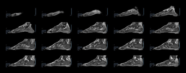 MRI Magnetic Resonance Scan image of the left foot to check for lumps on the soles of the feet.