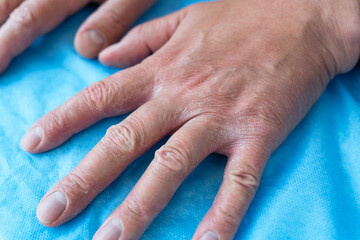 Treatment of dermatitis and psoriasis. Close-up of hands with very poor skin condition, cracked...