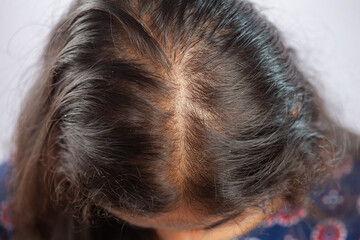 women with messy hair having hair falling or androgenetic alopecia