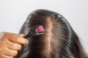 women using dermaroller for collagen induction therapy to treat androgenetic alopecia