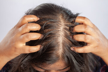 hair falling, women suffering from dandruff or head louse scratching her head with hands and showing bald patch on head - obrazy, fototapety, plakaty