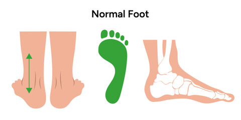 Normal foot