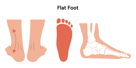 Flat foot deformity 