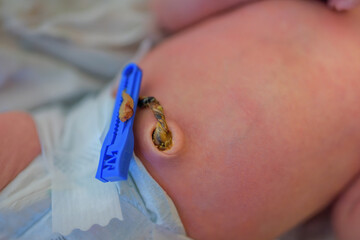 A dry cut umbilical cord on the belly of a newborn.
 - obrazy, fototapety, plakaty