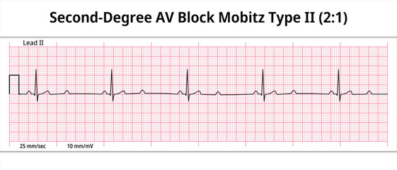 ECG Second Degree AV Block Mobitz Type 2 (2:1) - 8 Sec Electrocardiogram - Medical Vector Illustration