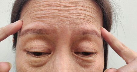 Woman with a headache, problem and stress, wrinkle and Flabby skin, forehead lines and loose, Flabbiness and scar on the face, health care and medical concept.