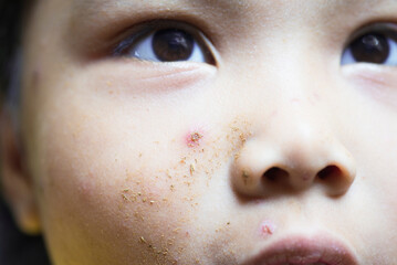 Symptoms of chickenpox in childhood