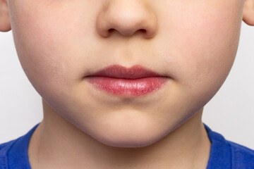 Dry chapped lips of a child close-up. Sensitive skin around the mouth and cheeks. Problems with peeling and redness of lips when licking in cold weather and wind. Dermatitis. Facial skin care concept