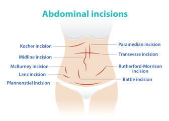Types of abdominal incision for surgery vector illustration isolated on white background. Kocher, Midline, McBurney, Lanz, Pfannenstiel, Paramedian, Transverse, Rutherford Morrison, Battle incision.