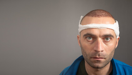 Caucasian man after hair transplantation. - obrazy, fototapety, plakaty