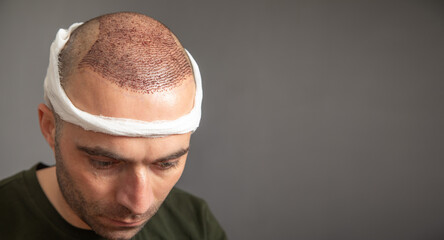 Caucasian man after hair transplantation. - obrazy, fototapety, plakaty