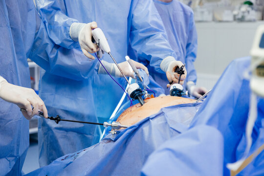 Doctor in blue sterile surgical gown doing surgery with camera and instrument. Keyhole surgery was perform in modern operating room. Advanced laparoscopy