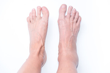 Top View of Woman's Feet, One with Sprained Ankle Swollen